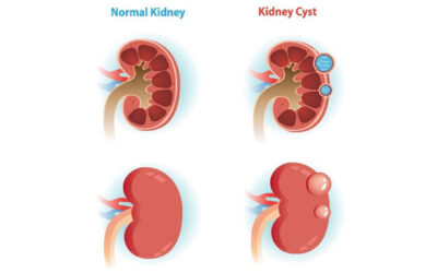 What are simple kidney cysts?