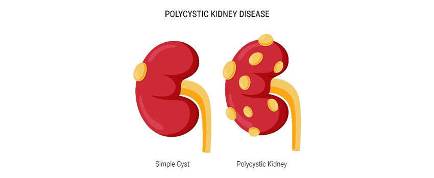 Polycystic kidney disease 