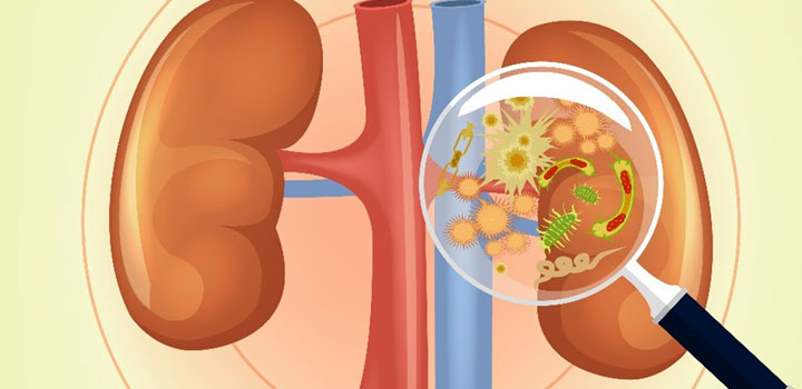What is a Kidney Infection? What are the causes and how are kidney infections treated?