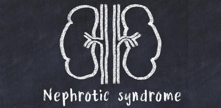 Fluid Insights: What Can You Learn About Nephrotic Syndrome?