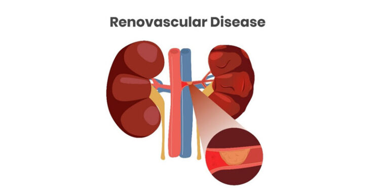 Understanding Renovascular Disease: A Comprehensive Overview