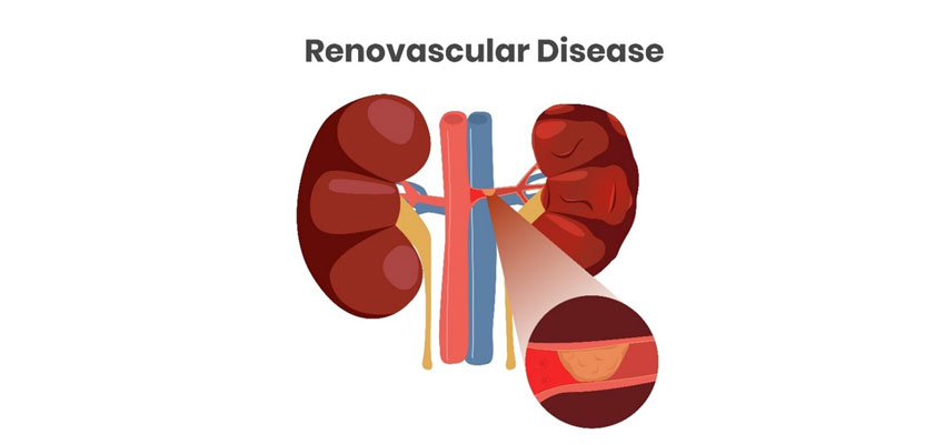 Understanding Renovascular Disease: A Comprehensive Overview