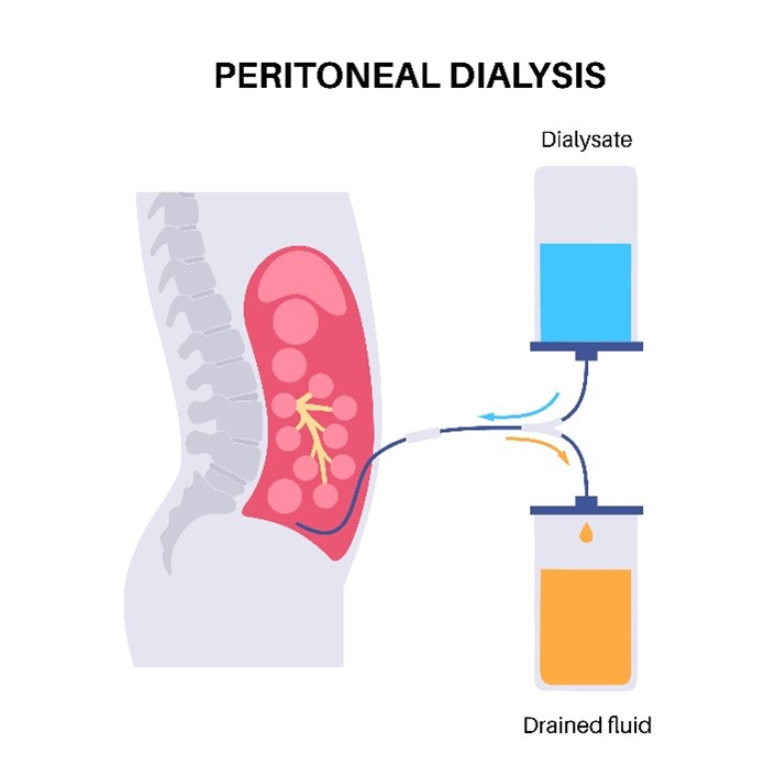 Peritoneal Dialysis