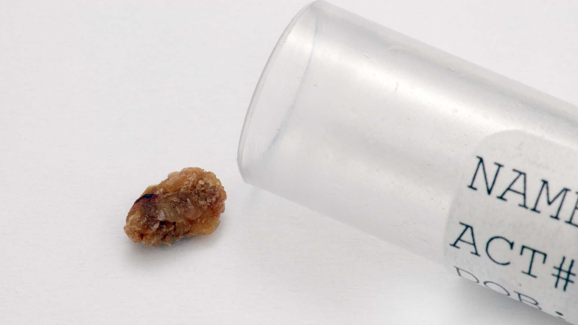 Kidney Stone Vial Image